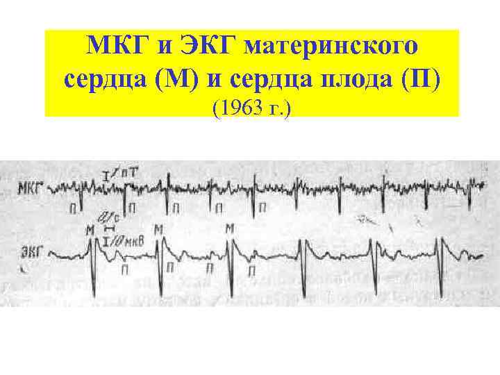 МКГ и ЭКГ материнского сердца (М) и сердца плода (П) (1963 г. ) 