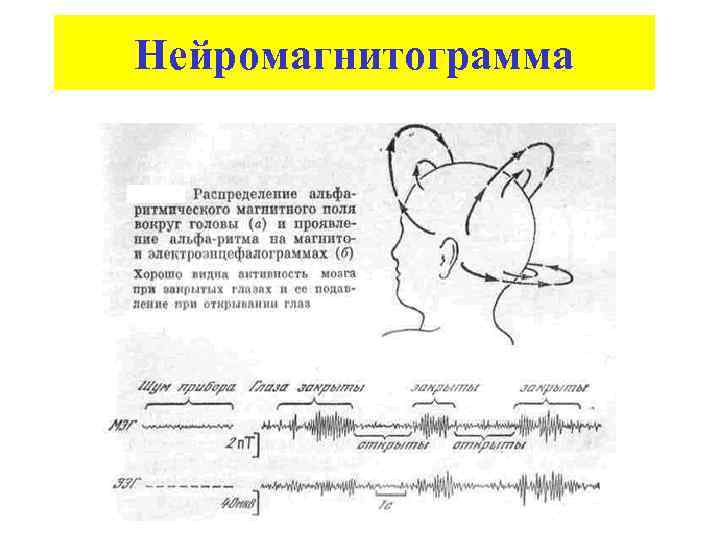 Нейромагнитограмма 