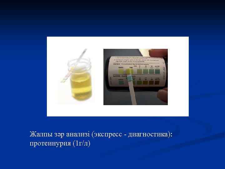 Жалпы зәр анализі (экспресс - диагностика): протеинурия (1 г/л) 