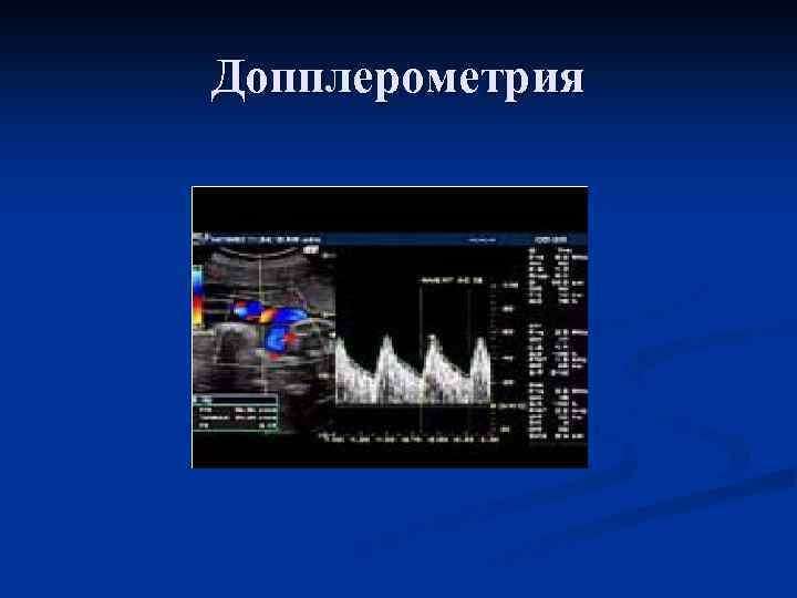 Допплерометрия 