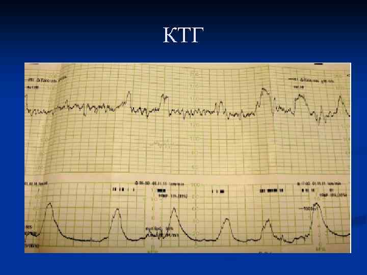 КТГ 