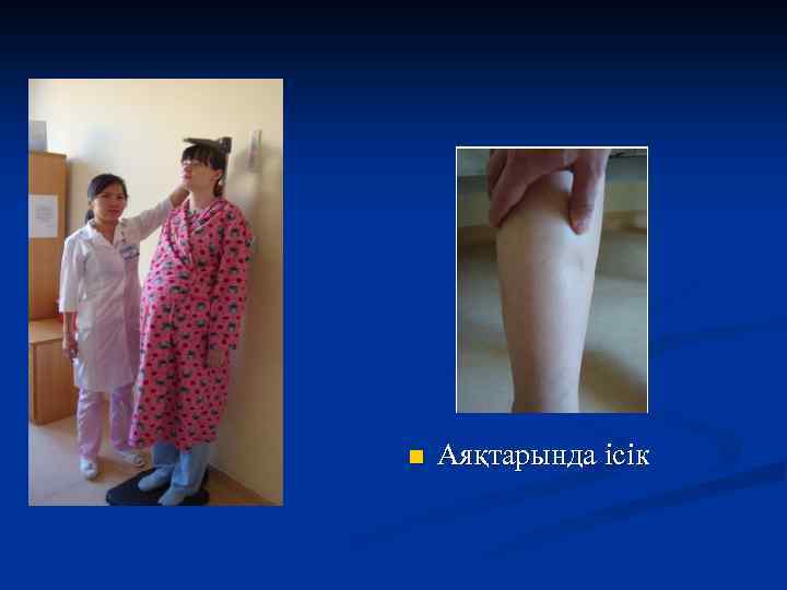 n Аяқтарында ісік 