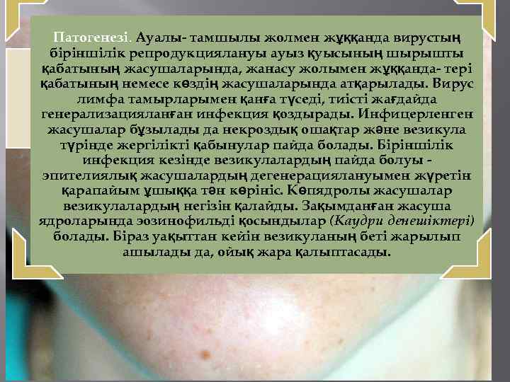 Патогенезі. Ауалы- тамшылы жолмен жұққанда вирустың біріншілік репродукциялануы ауыз қуысының шырышты қабатының жасушаларында, жанасу