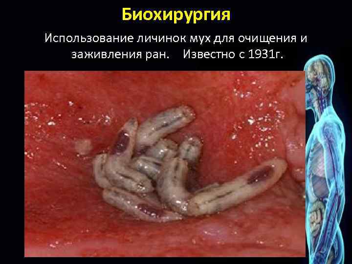 Биохирургия Использование личинок мух для очищения и заживления ран. Известно с 1931 г. 