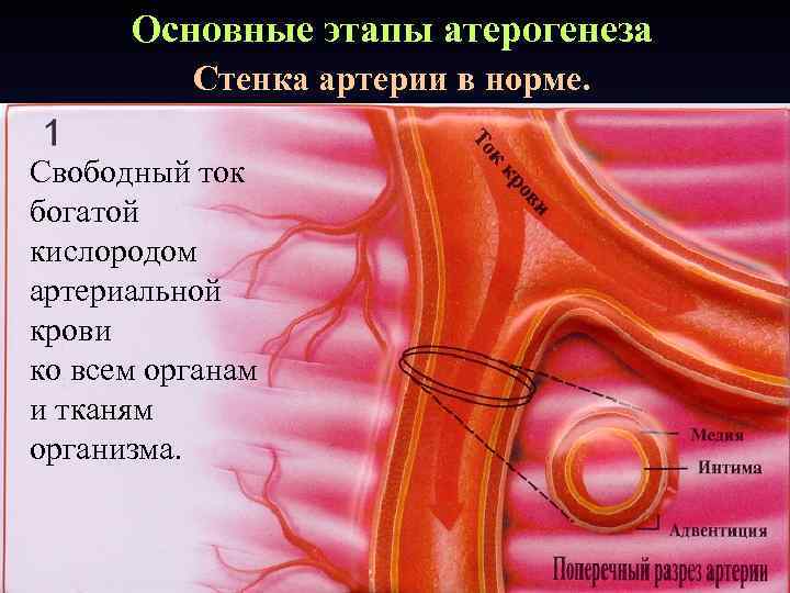 Основные этапы атерогенеза Стенка артерии в норме. Свободный ток богатой кислородом артериальной крови ко