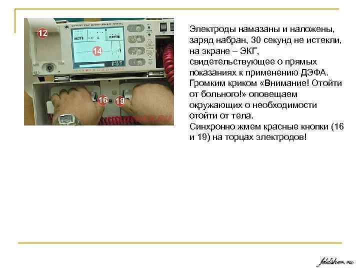 Электроды намазаны и наложены, заряд набран, 30 секунд не истекли, на экране – ЭКГ,