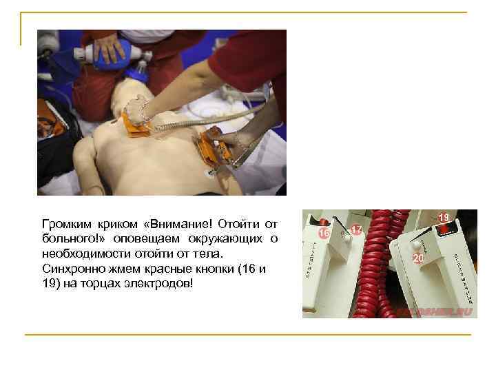 Громким криком «Внимание! Отойти от больного!» оповещаем окружающих о необходимости отойти от тела. Синхронно
