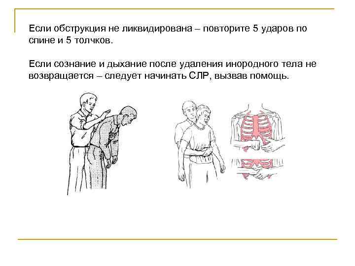 Если обструкция не ликвидирована – повторите 5 ударов по спине и 5 толчков. Если