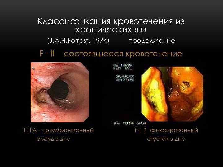 Классификация кровотечения из хронических язв (J. A. H. Forrest, 1974) F - II продолжение
