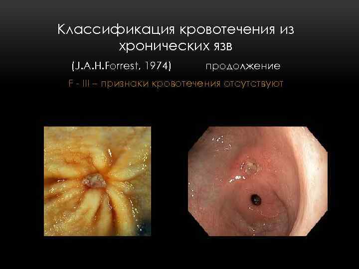 Классификация кровотечения из хронических язв (J. A. H. Forrest, 1974) продолжение F - III