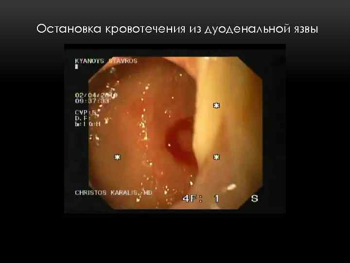 Остановка кровотечения из дуоденальной язвы Аргоно-плазменная коагуляция 
