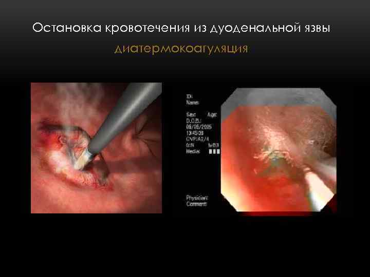 Остановка кровотечения из дуоденальной язвы диатермокоагуляция 