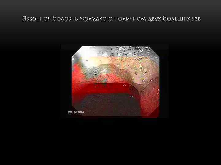 Язвенная болезнь желудка с наличием двух больших язв 