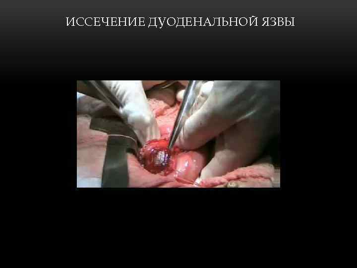 ИССЕЧЕНИЕ ДУОДЕНАЛЬНОЙ ЯЗВЫ 