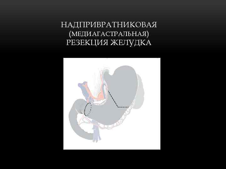 НАДПРИВРАТНИКОВАЯ (МЕДИАГАСТРАЛЬНАЯ ) РЕЗЕКЦИЯ ЖЕЛУДКА 