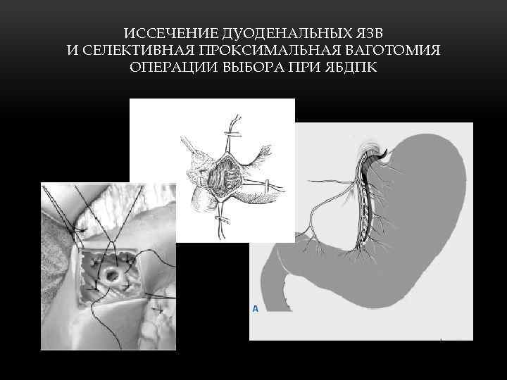 ИССЕЧЕНИЕ ДУОДЕНАЛЬНЫХ ЯЗВ И СЕЛЕКТИВНАЯ ПРОКСИМАЛЬНАЯ ВАГОТОМИЯ ОПЕРАЦИИ ВЫБОРА ПРИ ЯБДПК 