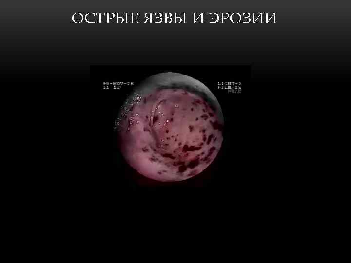 ОСТРЫЕ ЯЗВЫ И ЭРОЗИИ 