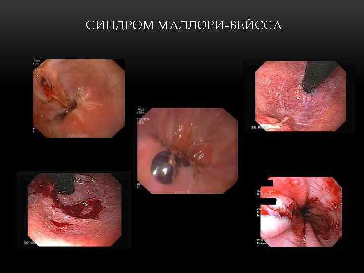 СИНДРОМ МАЛЛОРИ-ВЕЙССА 