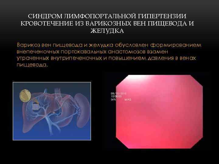 СИНДРОМ ЛИМФОПОРТАЛЬНОЙ ГИПЕРТЕНЗИИ КРОВОТЕЧЕНИЕ ИЗ ВАРИКОЗНЫХ ВЕН ПИЩЕВОДА И ЖЕЛУДКА Варикоз вен пищевода и