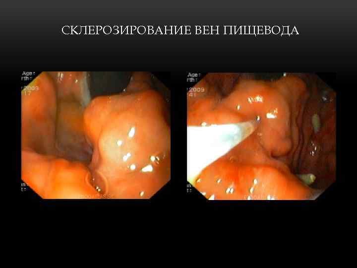 СКЛЕРОЗИРОВАНИЕ ВЕН ПИЩЕВОДА 
