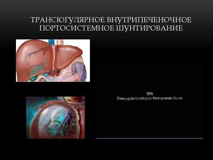 ТРАНСЮГУЛЯРНОЕ ВНУТРИПЕЧЕНОЧНОЕ ПОРТОСИСТЕМНОЕ ШУНТИРОВАНИЕ 
