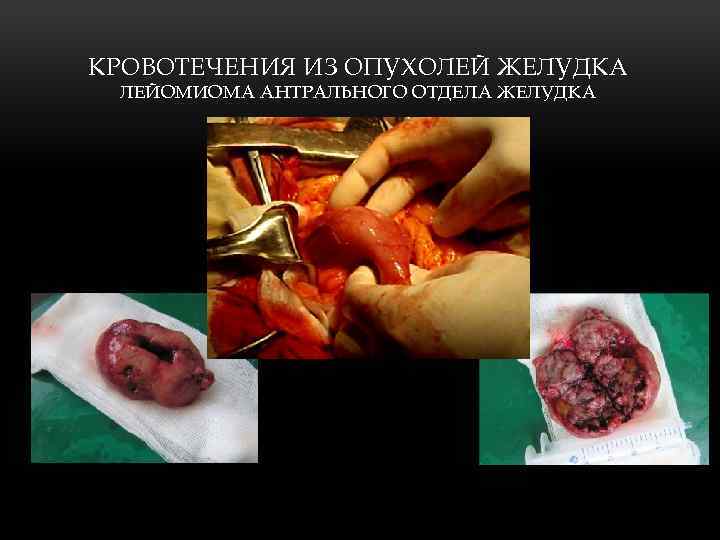 КРОВОТЕЧЕНИЯ ИЗ ОПУХОЛЕЙ ЖЕЛУДКА ЛЕЙОМИОМА АНТРАЛЬНОГО ОТДЕЛА ЖЕЛУДКА 