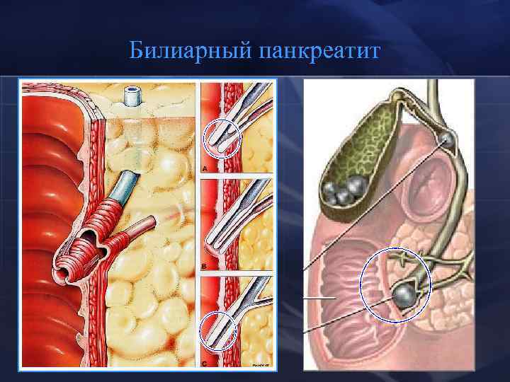 Билиарный панкреатит 