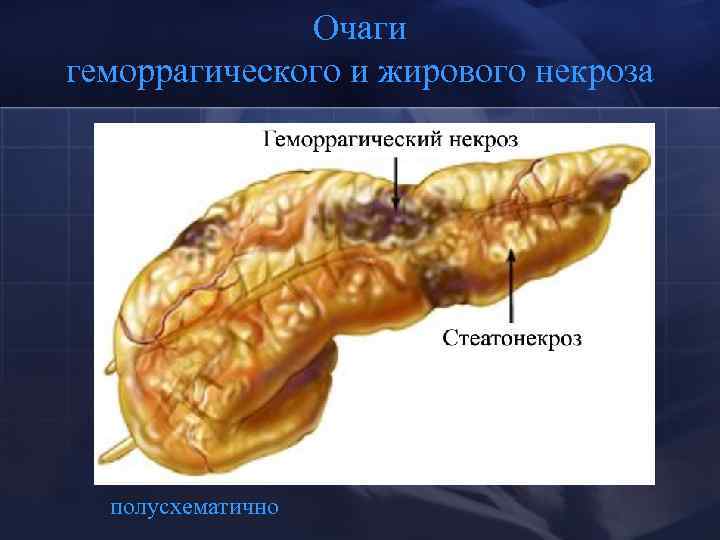 Очаги геморрагического и жирового некроза полусхематично 