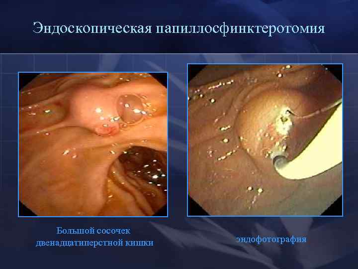 Эндоскопическая папиллосфинктеротомия Большой сосочек двенадцатиперстной кишки эндофотография 