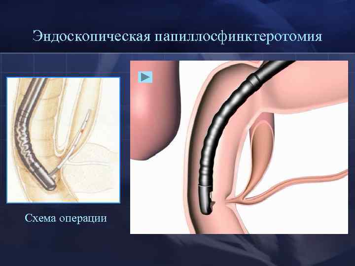 Эндоскопическая папиллосфинктеротомия Схема операции 