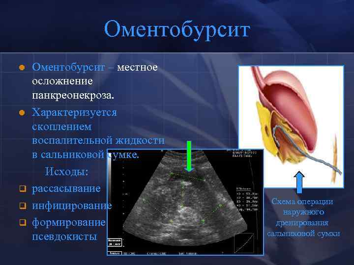 Панкреонекроз код по мкб 10