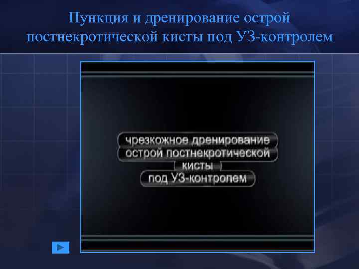 Пункция и дренирование острой постнекротической кисты под УЗ-контролем 