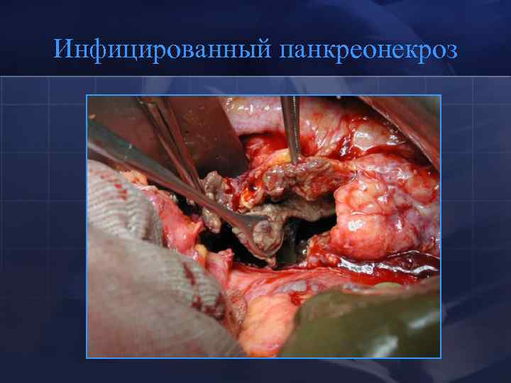 Инфицированный панкреонекроз 