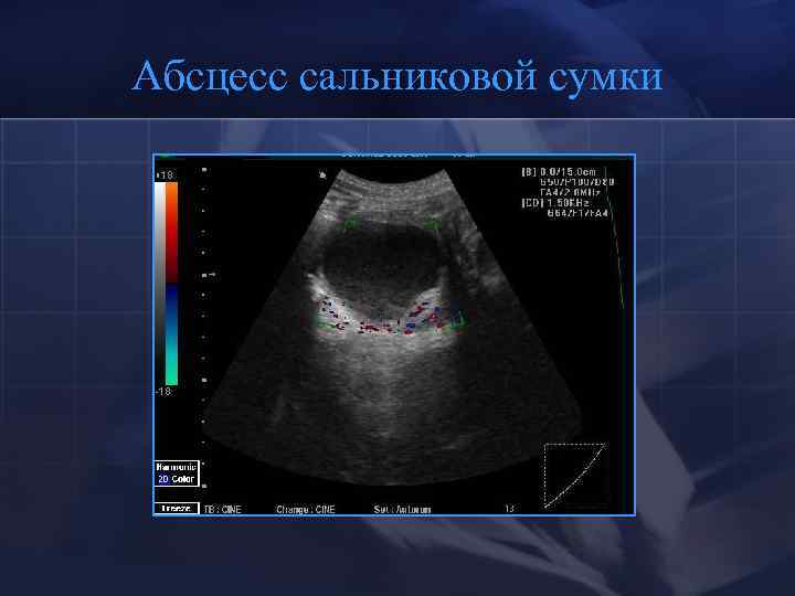 Абсцесс сальниковой сумки 