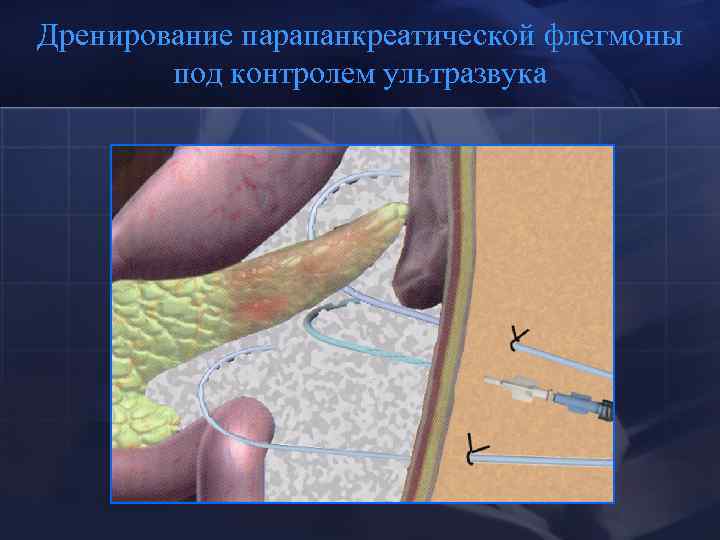 Дренирование парапанкреатической флегмоны под контролем ультразвука 