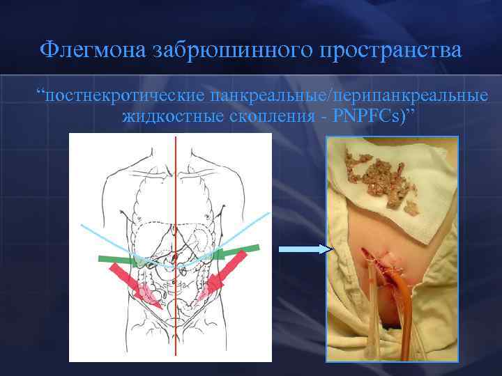 Флегмона забрюшинного пространства “постнекротические панкреальные/перипанкреальные жидкостные скопления - PNPFCs)” 