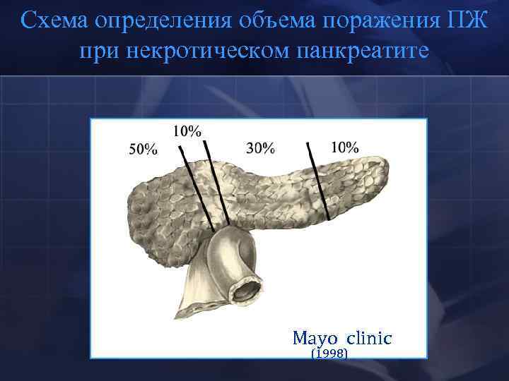 Схема определения объема поражения ПЖ при некротическом панкреатите Mayo cliniс (1998) 