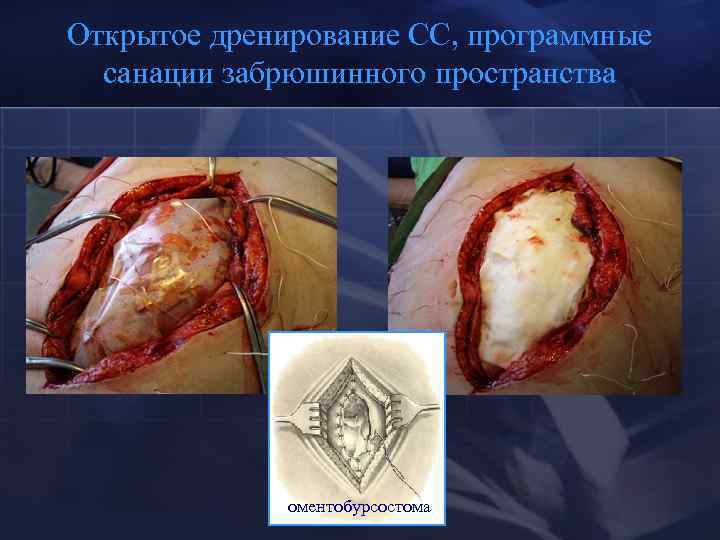 Открытое дренирование СС, программные санации забрюшинного пространства оментобурсостома 