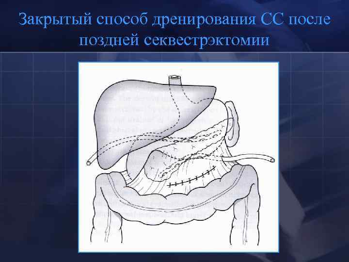 Закрытый способ дренирования СС после поздней секвестрэктомии 