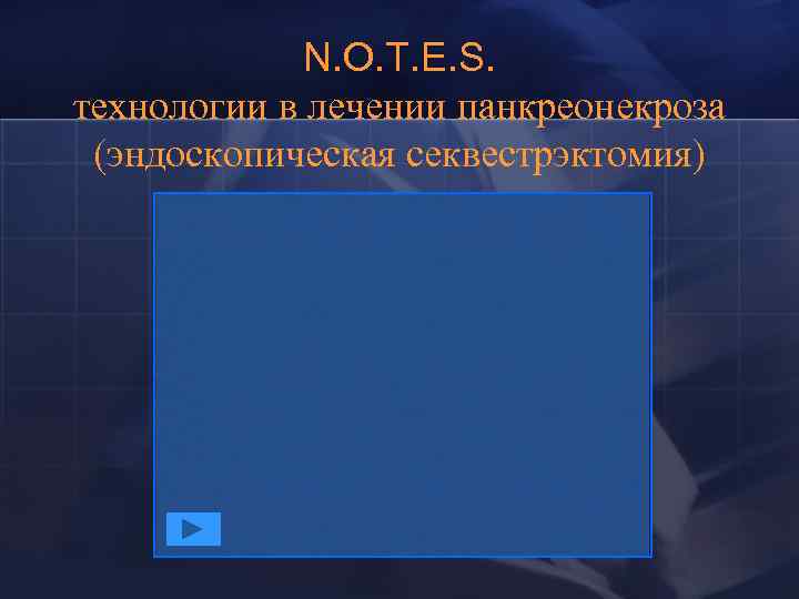 N. O. T. E. S. технологии в лечении панкреонекроза (эндоскопическая секвестрэктомия) 