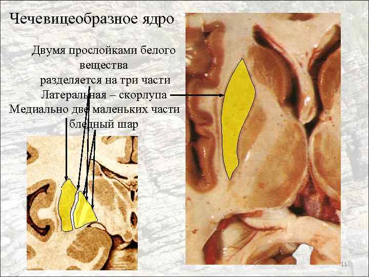 Чечевицеобразное ядро Двумя прослойками белого вещества разделяется на три части Латеральная – скорлупа Медиально