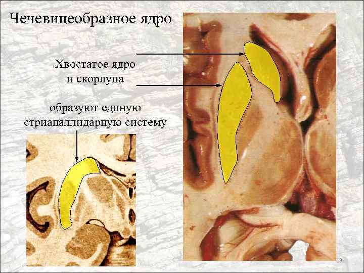 Чечевицеобразное ядро Хвостатое ядро и скорлупа образуют единую стриапаллидарную систему 13 