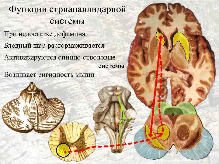 Функции стриапаллидарной системы При недостатке дофамина Бледный шар растормаживается Активизируются спинно-стволовые системы Возникает ригидность