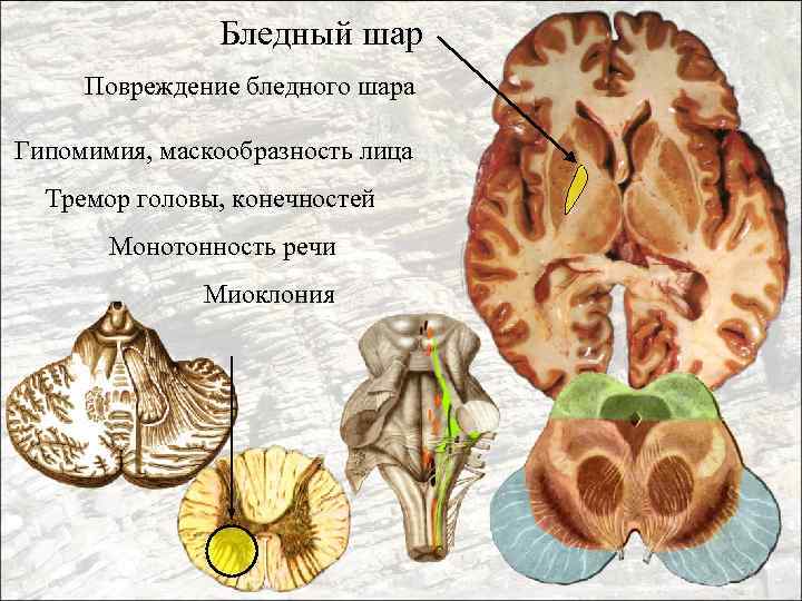 Бледный шар Повреждение бледного шара Гипомимия, маскообразность лица Тремор головы, конечностей Монотонность речи Миоклония