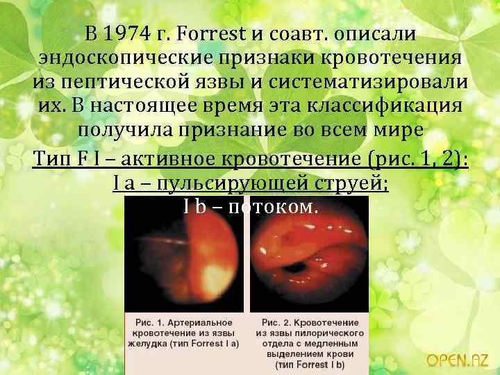 В 1974 г. Forrest и соавт. описали эндоскопические признаки кровотечения из пептической язвы и