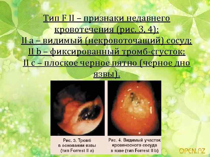 Тип F II – признаки недавнего кровотечения (рис. 3, 4): II а – видимый