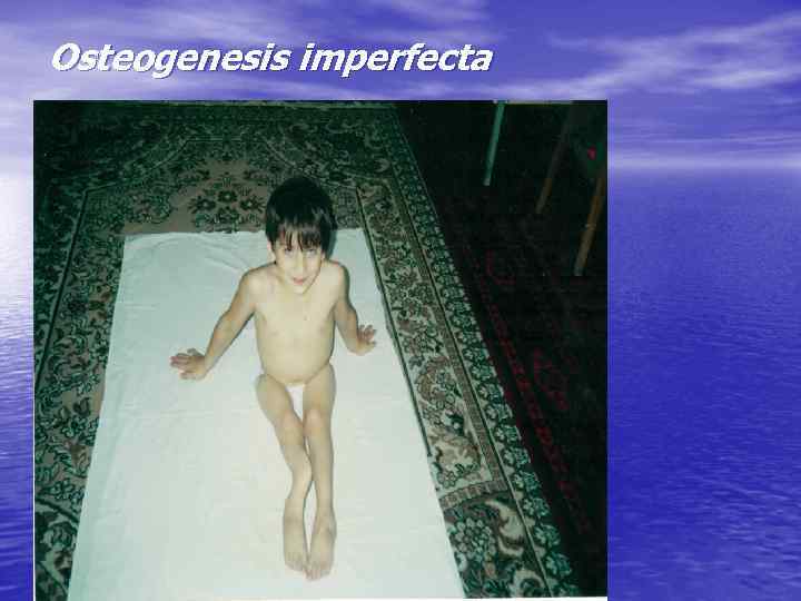 Osteogenesis imperfecta 