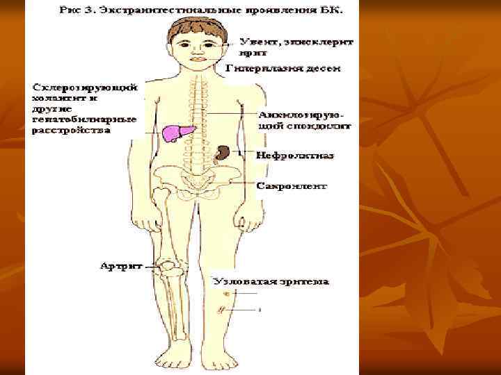 Гемоколит это. Синдром гемоколита. Гемоколит у новорожденных. Гемоколит у детей причины. Гемоколит у детей как выглядит.