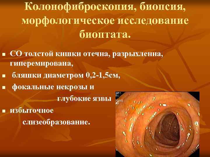 Колонофиброскопия, биопсия, морфологическое исследование биоптата. СО толстой кишки отечна, разрыхленна, гиперемирована, n бляшки диаметром