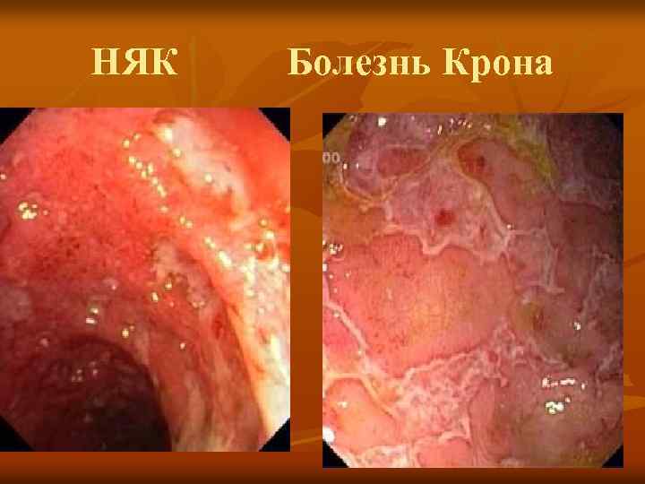 НЯК Болезнь Крона 